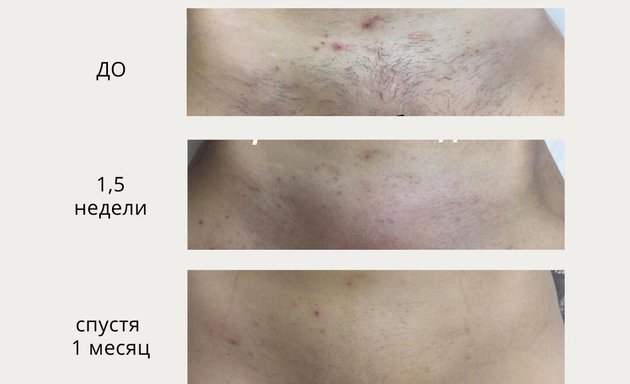 Elos эпиляция. Лазерная эпиляция до и после. Лазерная эпиляция для мужчин. Лазерная эпиляция. Лазерная эпиляция для мужчин.
